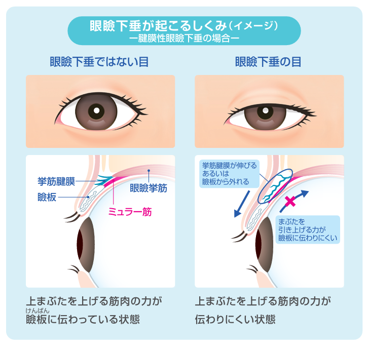 眼瞼下垂